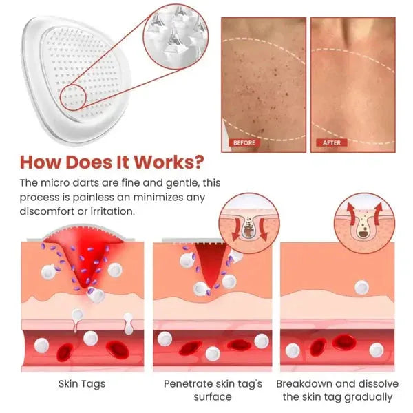 ✨ DermaSmooth™ Skin Tag Removal Patches | Safe, Painless & Fast-Acting Formula