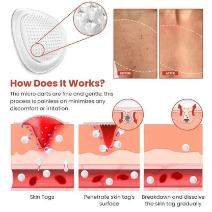 ✨ DermaSmooth™ Skin Tag Removal Patches | Safe, Painless & Fast-Acting Formula