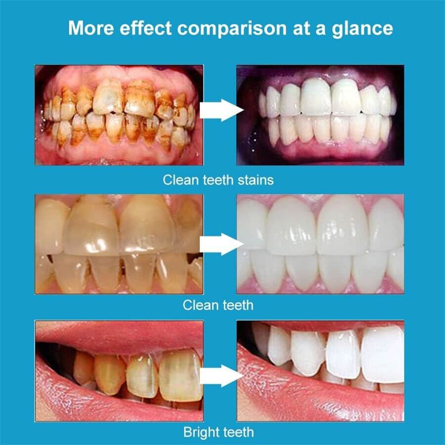 Professional Teeth Whitening & Stain Removing Pen Gel Pen