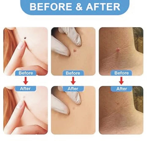 ✨ DermaSmooth™ Skin Tag Removal Patches | Safe, Painless & Fast-Acting Formula